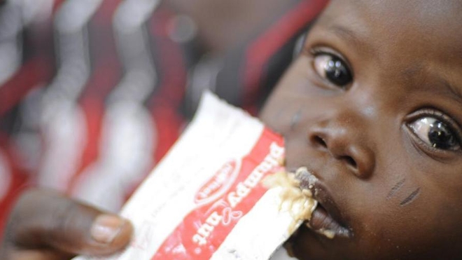 Au Burkina Faso, de nombreux enfants sont malnutris