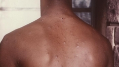 Au Cameroun, la varicelle fait des siennes...