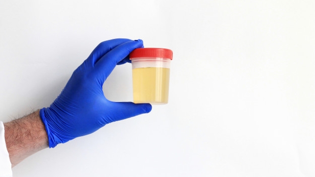 Analyse d'urine... pourquoi et comment on en fait ?