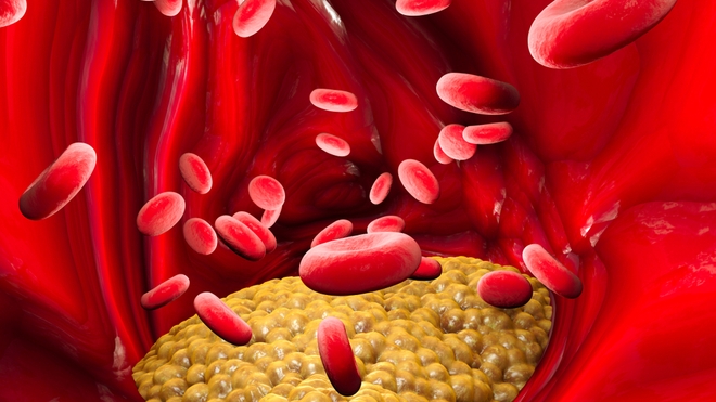 Quand il pénètre à l'intérieur des artères, le mauvais cholestérol peut provoquer une maladie cardiovasculaire