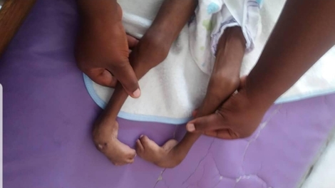 Cameroun : Une consultation gratuite pour les personnes qui souffrent de pieds bots