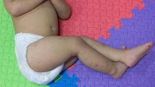 Mon enfant a la varicelle, que faire ?