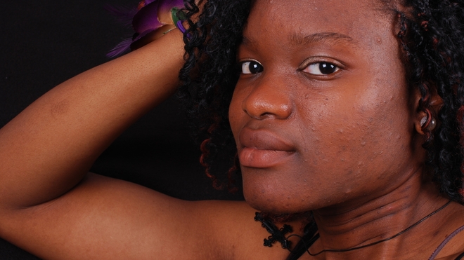 Pour les adolescents, l'acné est une véritable injustice