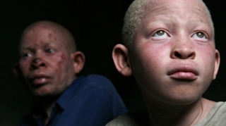Quiz : Connaissez-vous bien l'albinisme ?