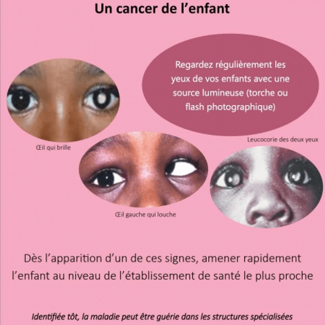 Le Retinoblastome Le Cancer De L Oeil De L Enfant Allodocteurs