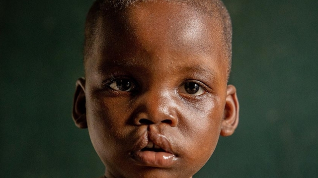 Fente labiale : le Sénégal veut mieux soigner le bec de lièvre