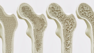 L'ostéoporose : une maladie silencieuse qui n'épargne pas l'Afrique