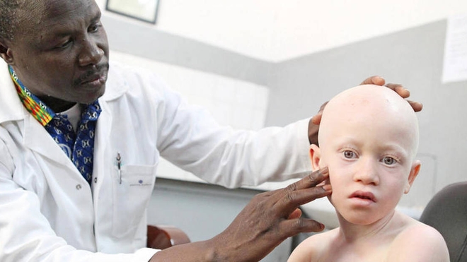La Fondation Pierre Fabre multiplie ses efforts en faveur des personnes atteintes d'albinisme (photo d'illustration)
