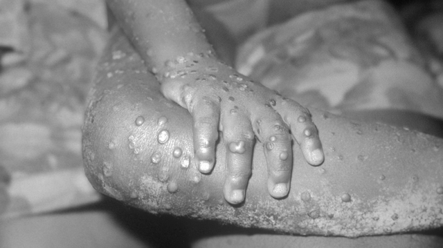 La variole du singe continue de sévir en RD Congo