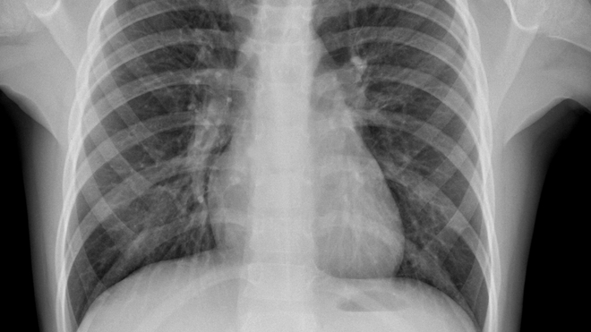 Le nombre de décès lié à la tuberculose commence à baisser