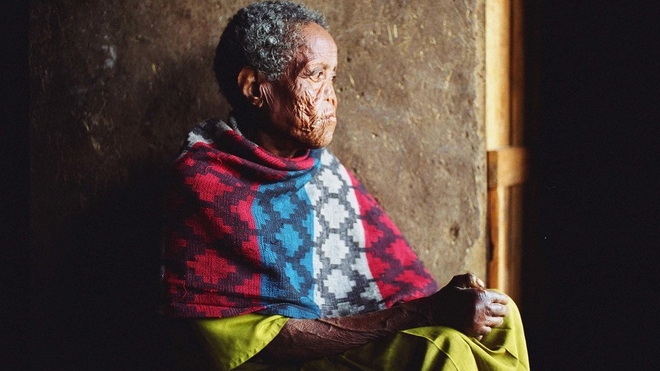 Une personne affectée par la lèpre à Addis Abeba, en Ethiopie
