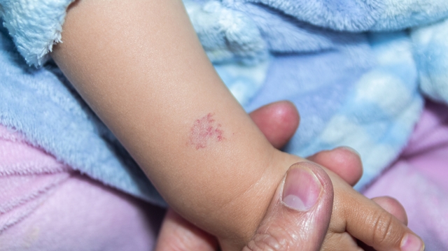 Tâche rouge sur le dos ou le visage de votre bébé... comment faire disparaître l'angiome ?