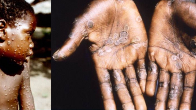 En RD Congo, la variole du singe gagne du terrain