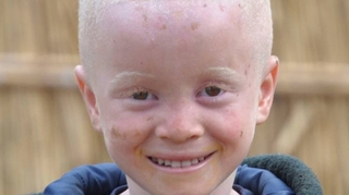 Il ne fait pas bon être albinos à Madagascar