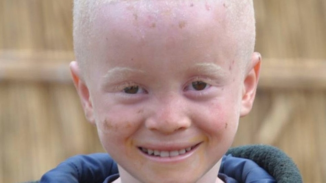 Les enfants atteints d'albinisme sont souvent victimes de discriminations