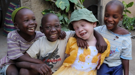 Nos conseils pour bien vivre son albinisme