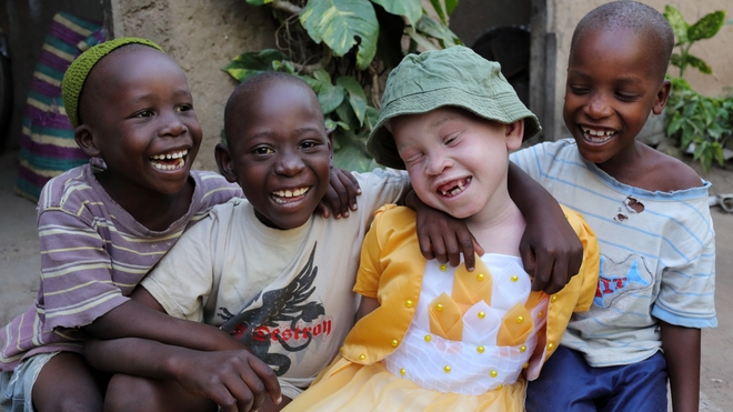 Le Rwanda veut faciliter l'accès aux crèmes solaires pour les albinos (photo d'illustration)