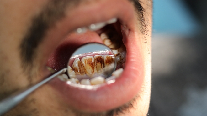Le tartre dentaire peut être dangereux 