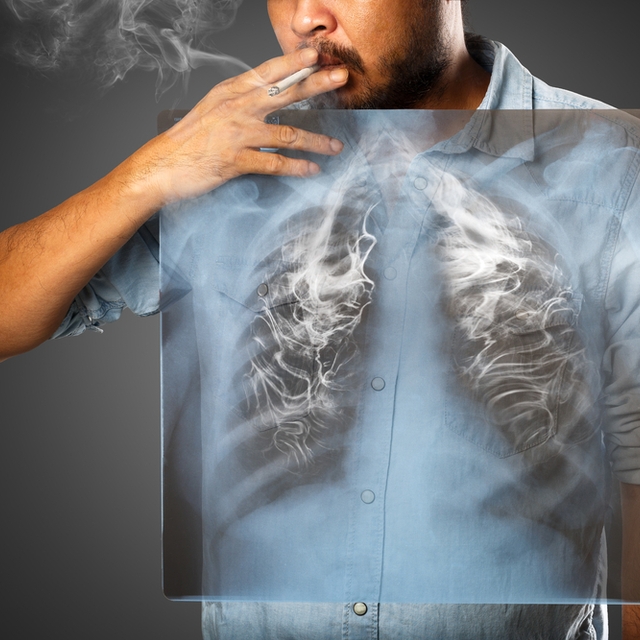 Cinq idées reçues sur le cancer du poumon
