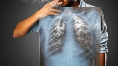 Cinq idées reçues sur le cancer du poumon