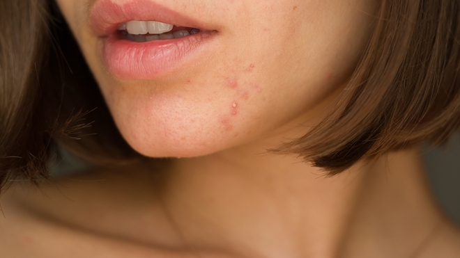 L'acné hormonale chez une femme