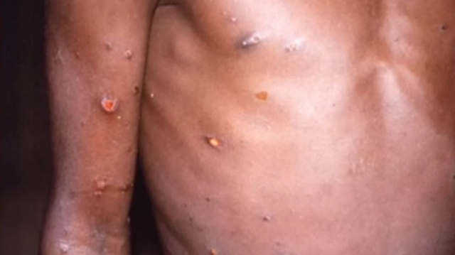 La variole du singe gagne du terrain en Afrique de l’Ouest