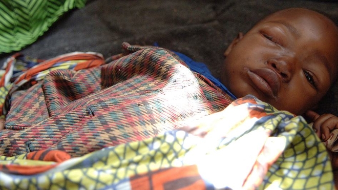 Un garçon souffrant de la variole du singe se repose dans un centre de santé d'un camp de déplacés du Nord-Kivu, en République démocratique du Congo