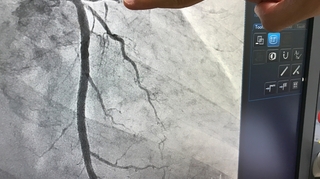Cathétérisme cardiaque, coronarographie... ces nouveaux examens du cœur à l'hôpital général de Douala