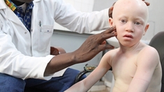 La cherté de la crème solaire tue des Sénégalais atteints d'albinisme 