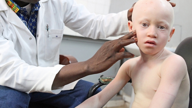 Le soleil est l'ennemi numéro 1 des personnes atteintes d'albinisme 