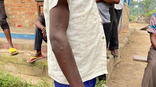 En RD Congo, mieux informer pour lutter contre la variole du singe