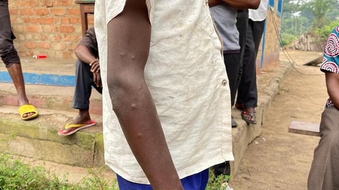 Enfant présentant des signes de la variole du singe dans la zone de santé de Kibombo