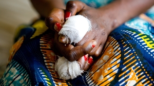En RD Congo, la détection de la lèpre s'intensifie 