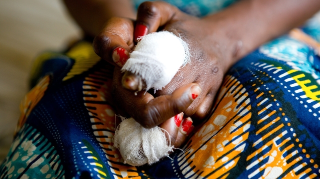En RD Congo, la détection de la lèpre s'intensifie 