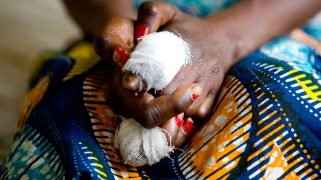 Une Congolaise atteinte par la lèpre