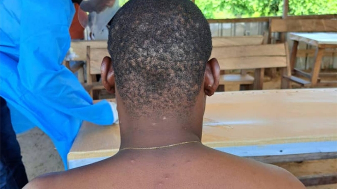 Un patient nigérian atteint de variole du singe 