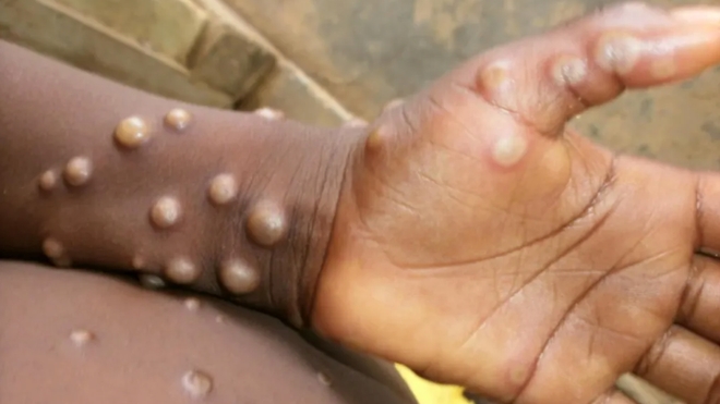 Les symptômes de la variole du singe sont nombreux