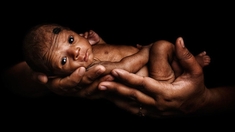 Au Congo-Brazzaville, beaucoup de bébés sont trop petits à la naissance