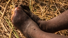 Éléphantiasis, bilharziose... le Sénégal veut venir à bout des maladies tropicales négligées