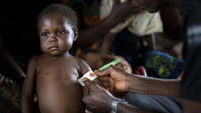 Nombreux sont les enfants qui souffrent de malnutrition en RD Congo