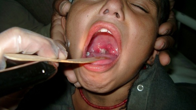 Un jeune patient atteint de diphtérie en Afghanistan