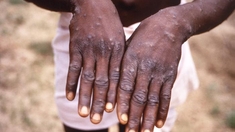 Une nouvelle souche plus mortelle de variole du singe détectée en RD Congo