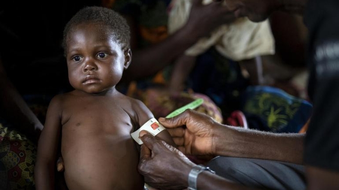 La malnutrition est l'une des principales causes de décès chez les enfants de moins de 5 ans