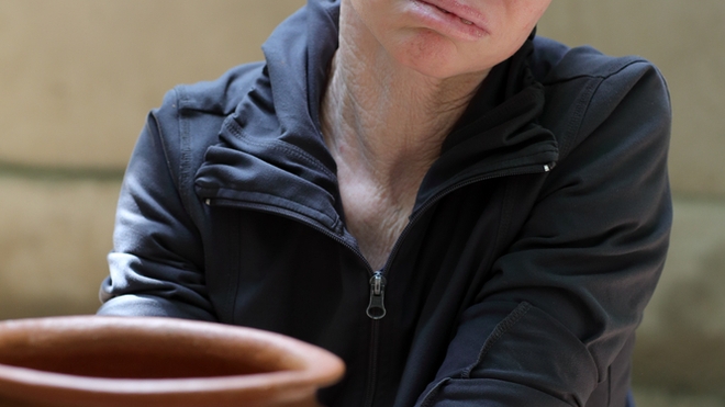 Les personnes albinos sont plus vulnérables aux cancers de la peau (photo d'illustration)