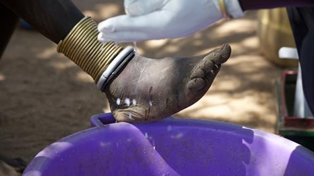 Maladie du ver de Guinée : un dernier pas avant l'éradication ?