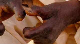 En RD Congo, la lèpre détruit des vies !