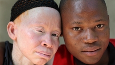Albinisme : les violences ont augmenté pendant la pandémie