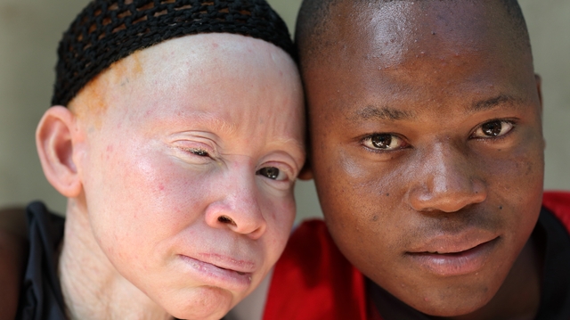 Les albinos, toujours victimes des fausses croyances