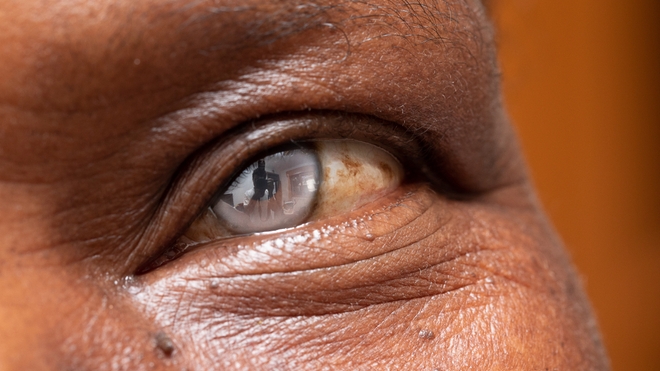 La cataracte est l'une des maladies les plus fréquentes en Afrique (photo d'illustration)