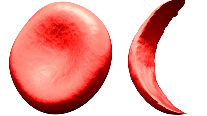 La drépanocytose transforme les globules rouges en une sorte de croissant (photo d'illustration)